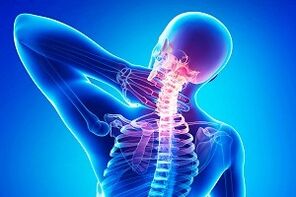 Rückenschmerzen als Symptom einer Osteochondrose