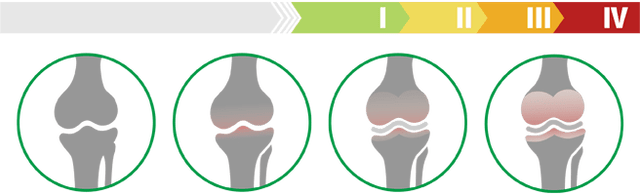 Klinische Stadien der Kniegelenksarthrose (Arthrosegrad des Kniegelenks)