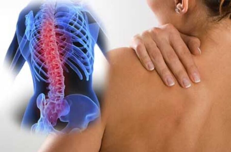 Bei einer Exazerbation einer Osteochondrose der Brustwirbelsäule treten Dorsago-Schmerzen auf