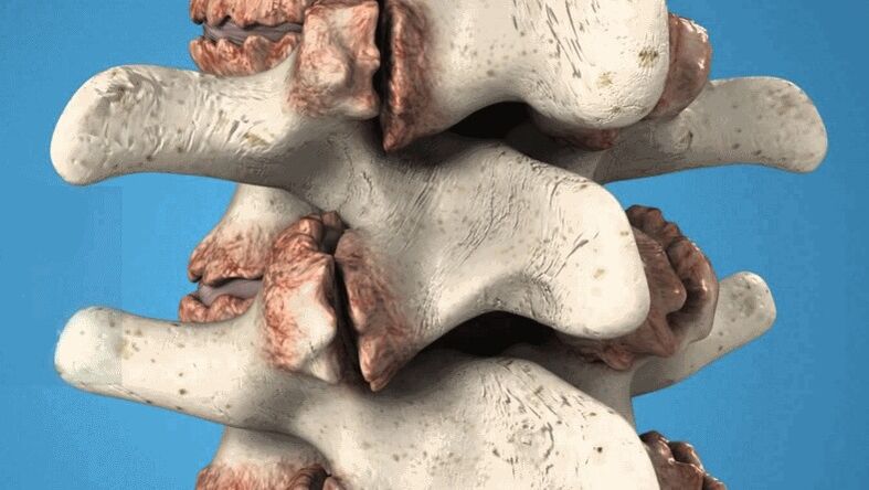 Osteophyten der Wirbelsäule als Ursache für Rückenschmerzen