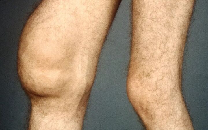 Post -traumatische Arthrose des Kniegelenks