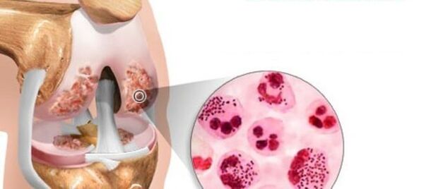 Dies führt zur Entwicklung von Arthrose