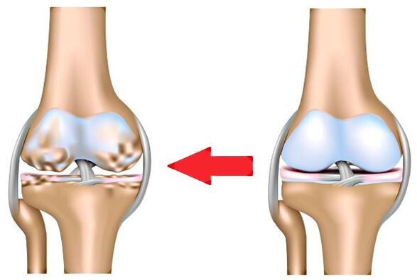 Gesunde Gelenk und Arthrose
