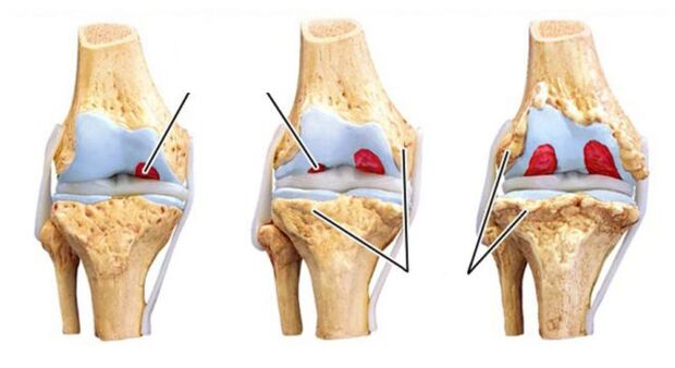 Komplikationen der Arthrose der Gelenke